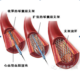 冠脉支架植入.jpg